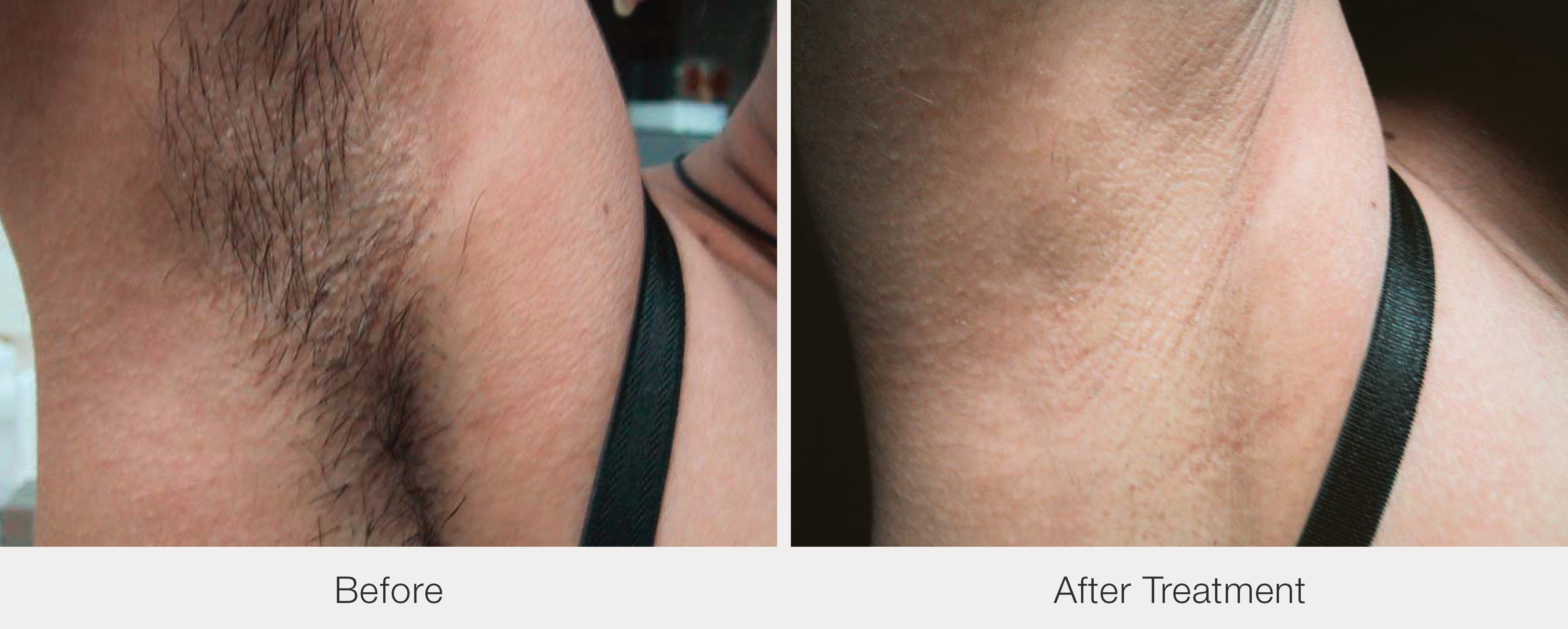 Underarm hair removal