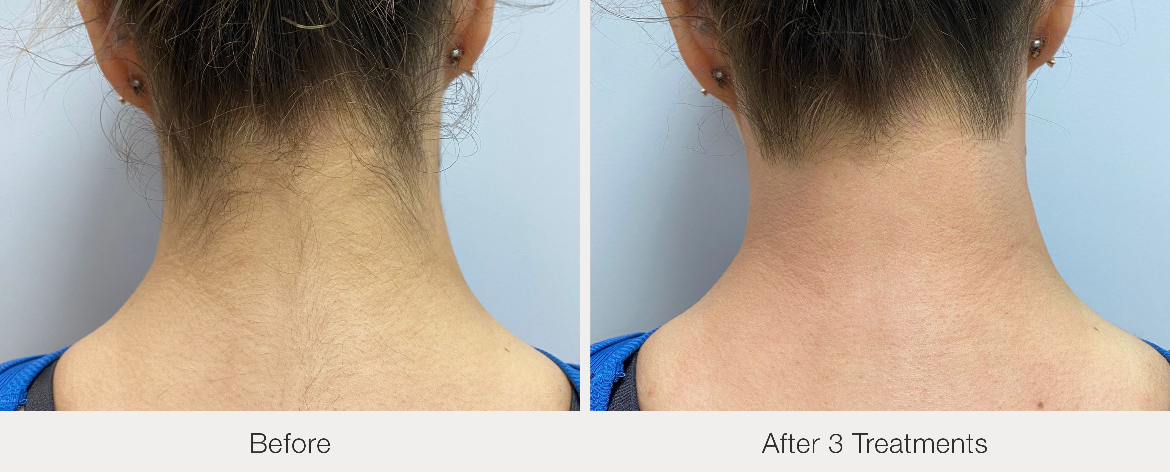 Neck hair removal after 3 treatments