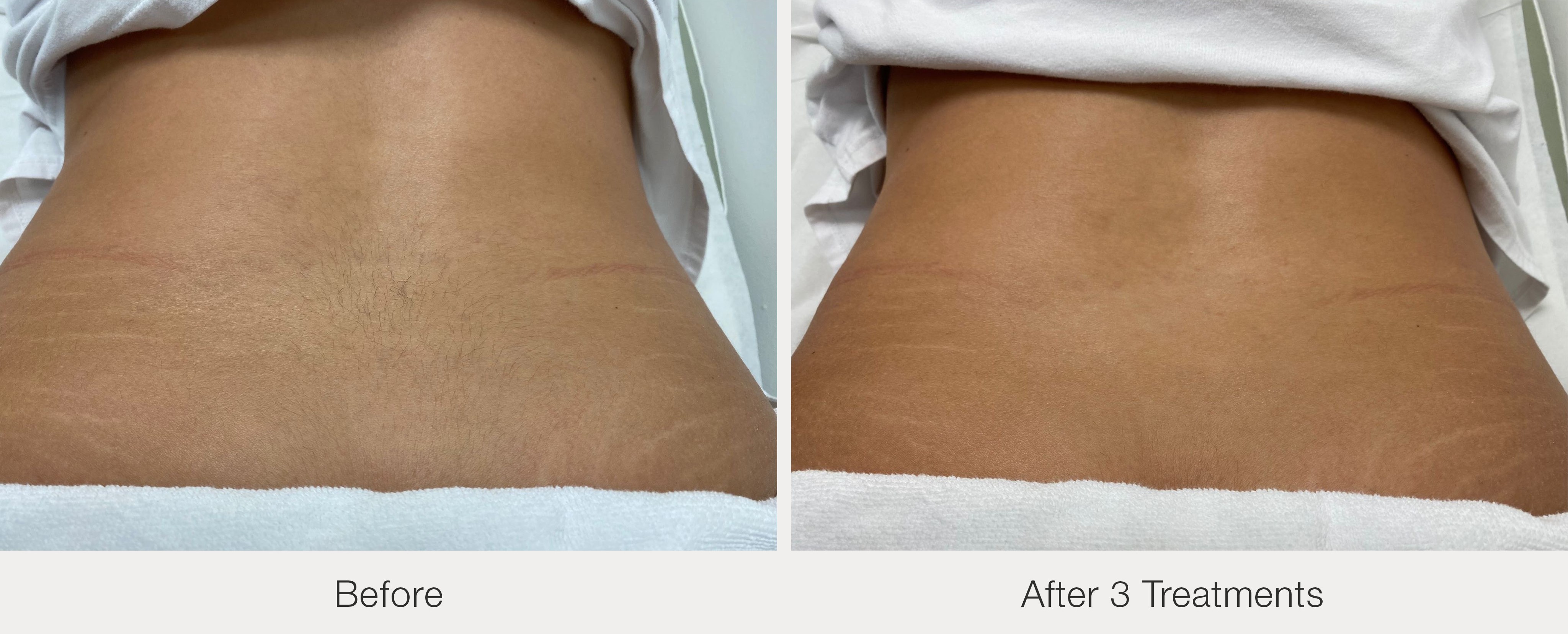 Lower back hair removal after 3 treatments