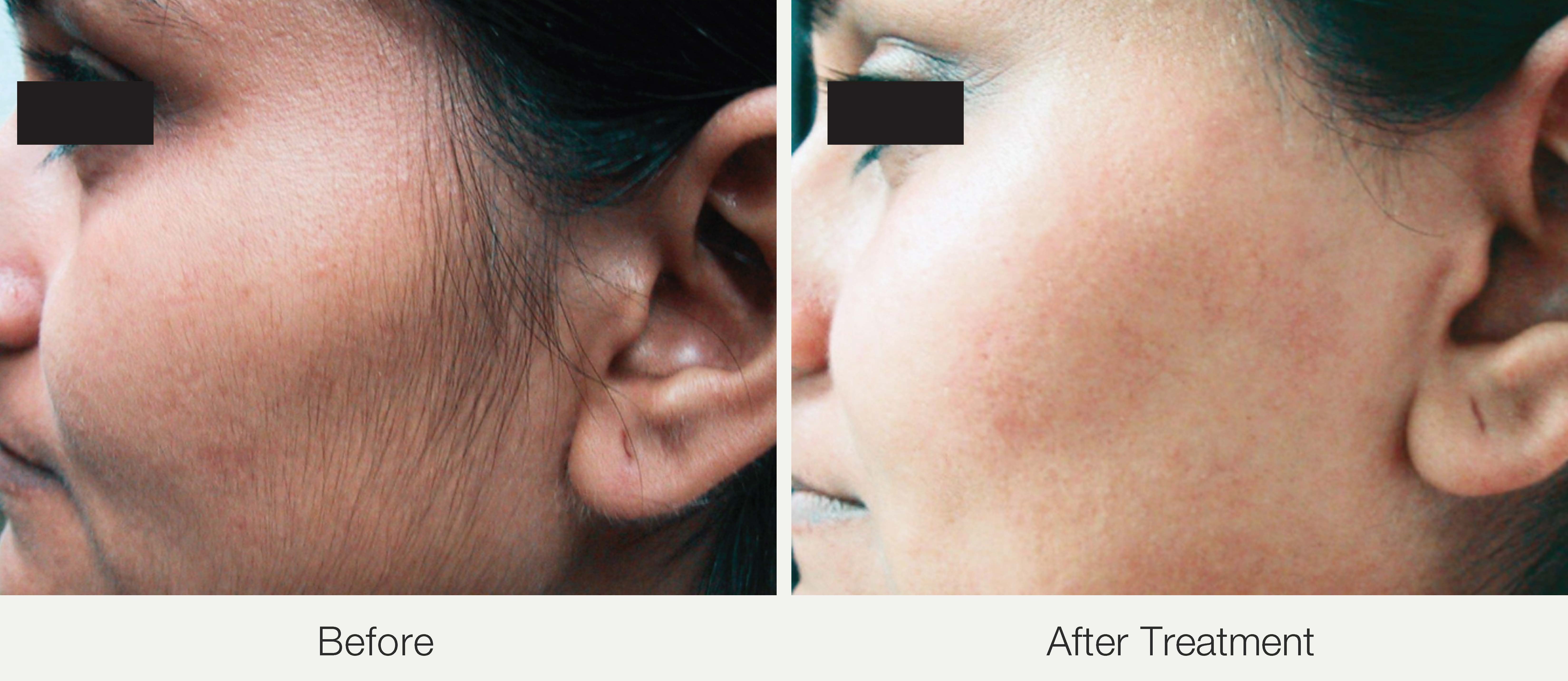Face/Sideburns hair removal
