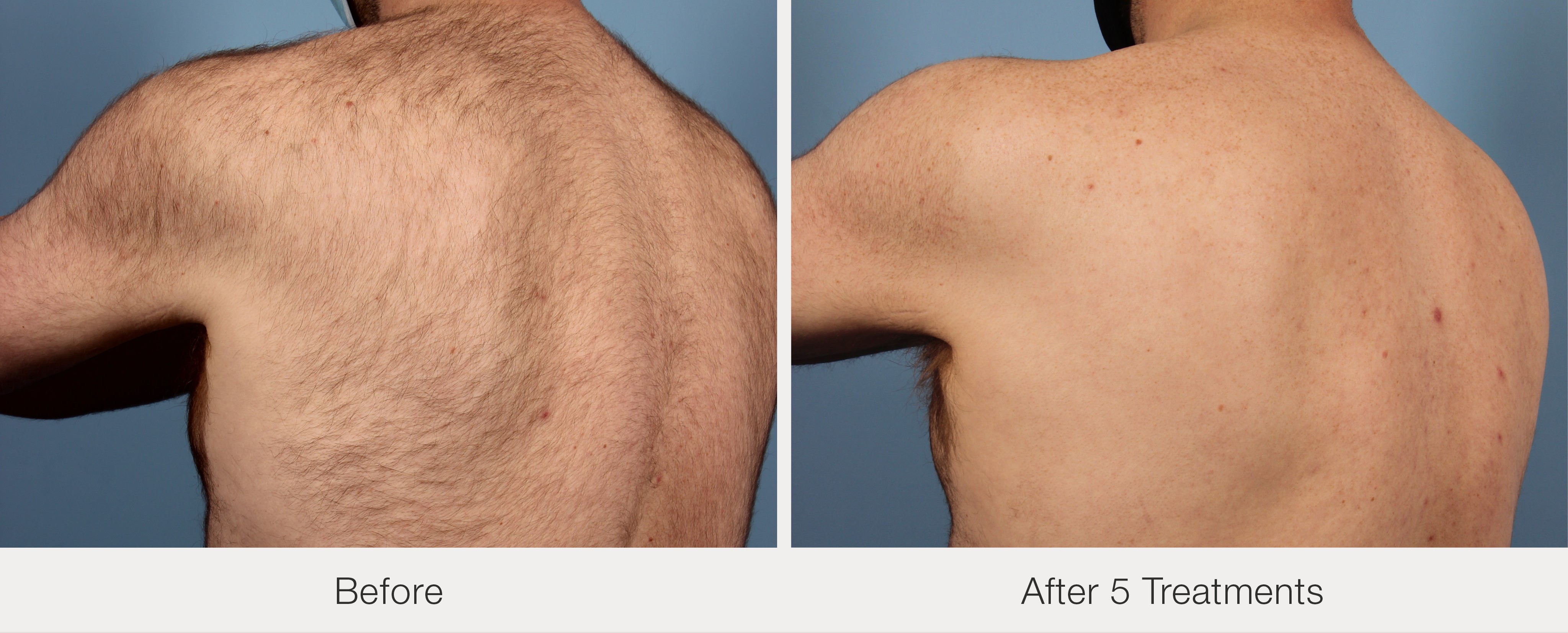 Back and Shoulders hair removal after 5 treatments
